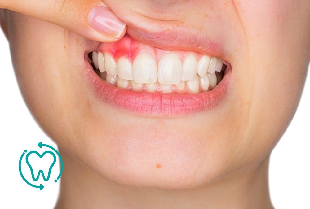 La enfermedad periodontal, una amenaza silenciosa para la salud bucal